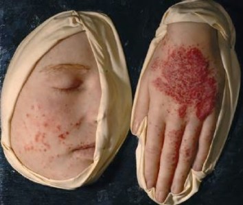 moulage_konzaktekzem